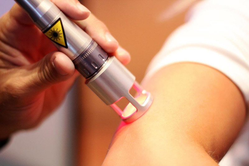 Low-level laser therapy for neuropathic pain treatment