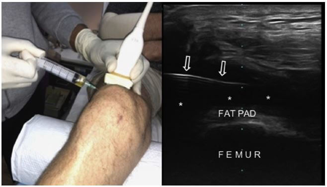 Ultrasound-Guided Injection